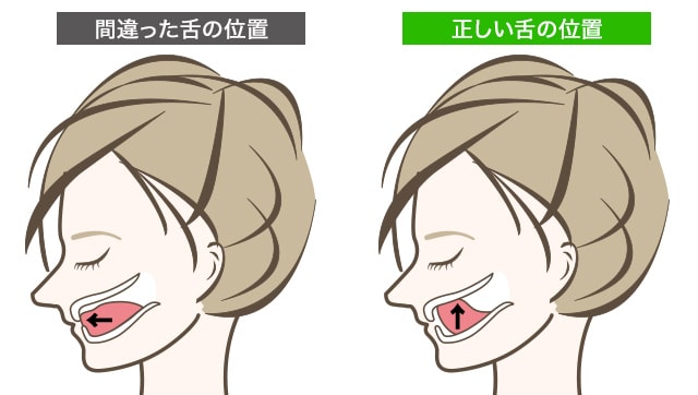 間違った舌の位置と正しい舌の位置