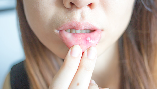 痛い口内炎には漢方薬が効果的？口内炎におすすめの食材と漢方薬「黄連解毒湯」