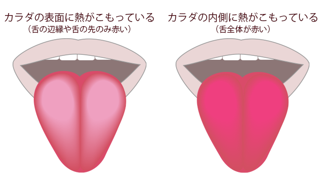 “漢方流！舌を使って簡単に熱の居場所を見分けよう”