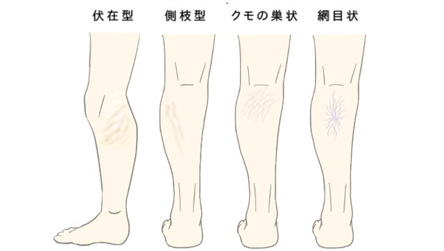 ４種類の下肢静脈瘤のイラスト
