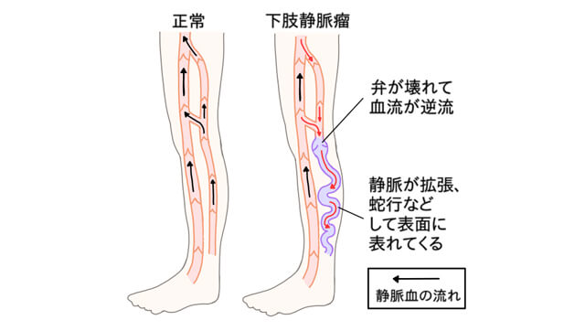 下肢静脈瘤の説明イラスト