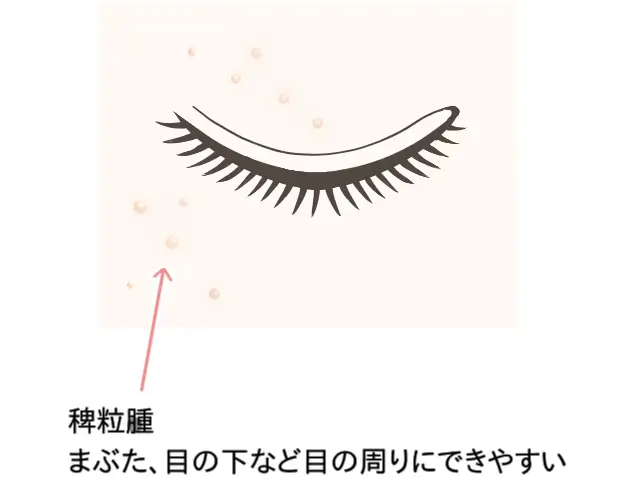 稗粒腫イメージイラスト