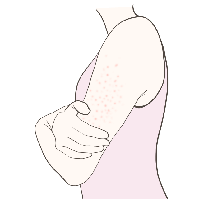 毛孔性苔癬イメージイラスト