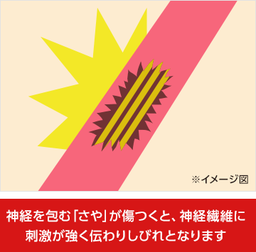 神経を包む「さや」が傷つくと、神経繊維に刺激が強く伝わりしびれとなります