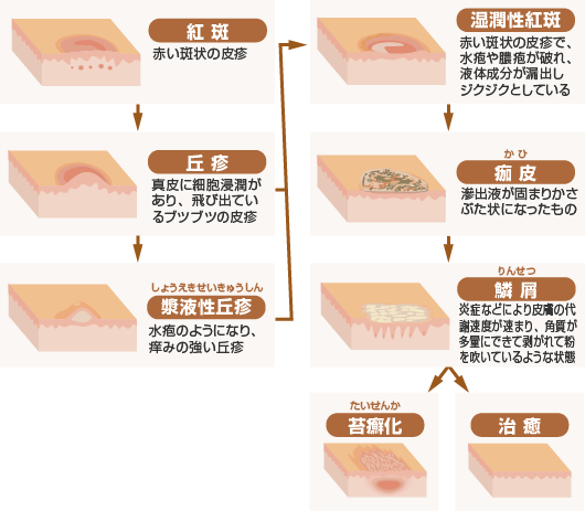 アトピー性皮膚炎の原因とは 漢方療法推進会 クラシエ