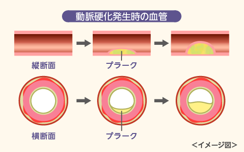 動脈硬化発生時の血管※イメージ図
