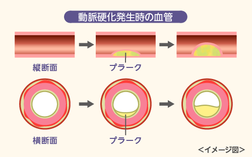 動脈 硬化 と は