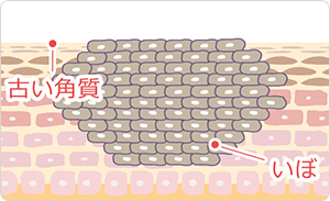 いぼができた状態の肌