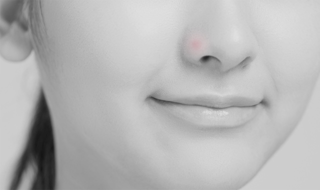 てっぺん 鼻 ニキビ 意味 の 鼻のニキビ占いの意味とは？鼻の下・横・小鼻・鼻筋・鼻の頭